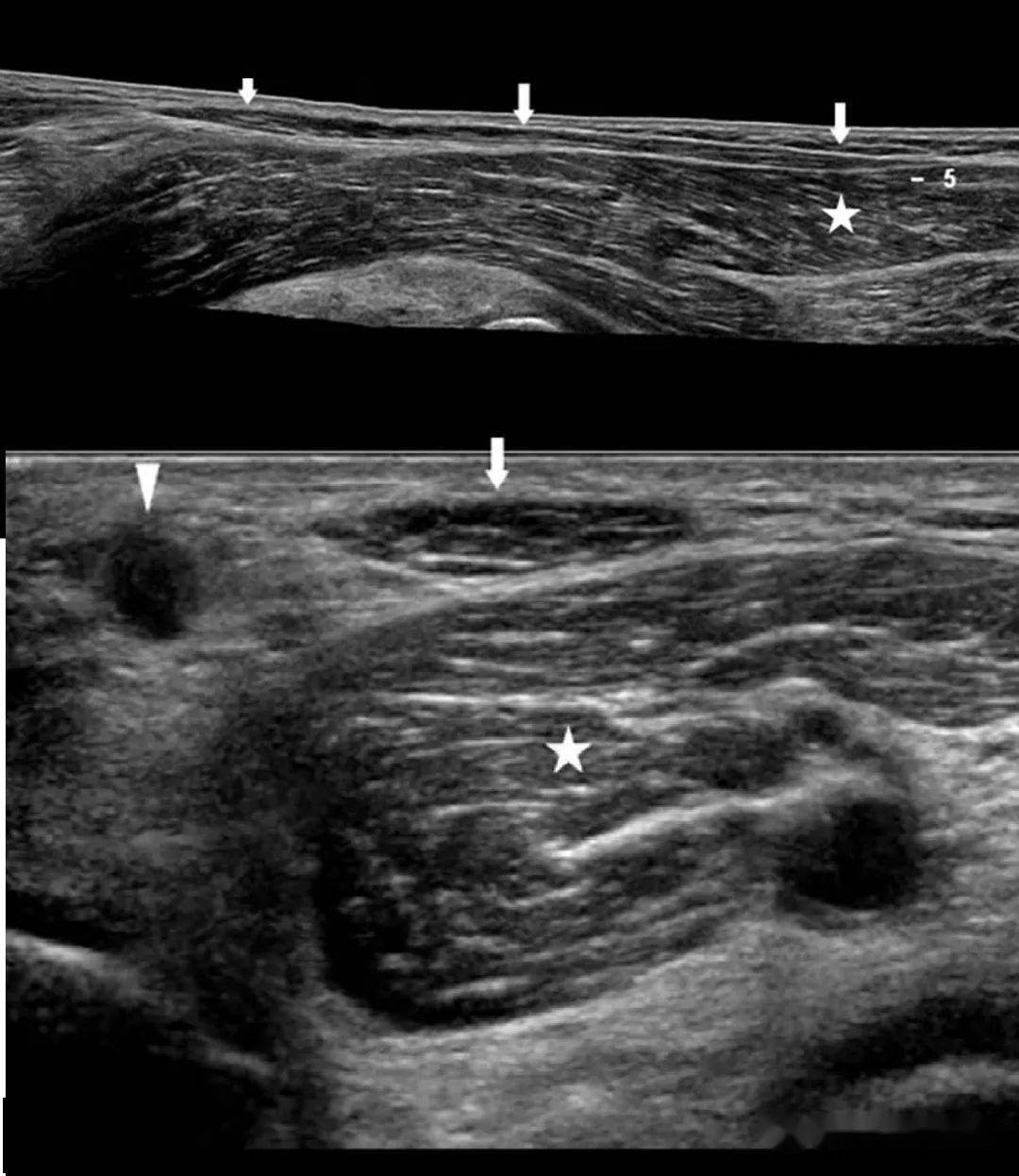 超声横断图像显示 腓肠筋膜张肌(箭头)位于腓肠肌内侧头后方(星号)和