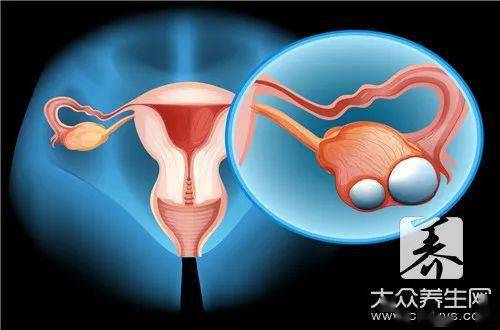 卵巢癌的症状表现