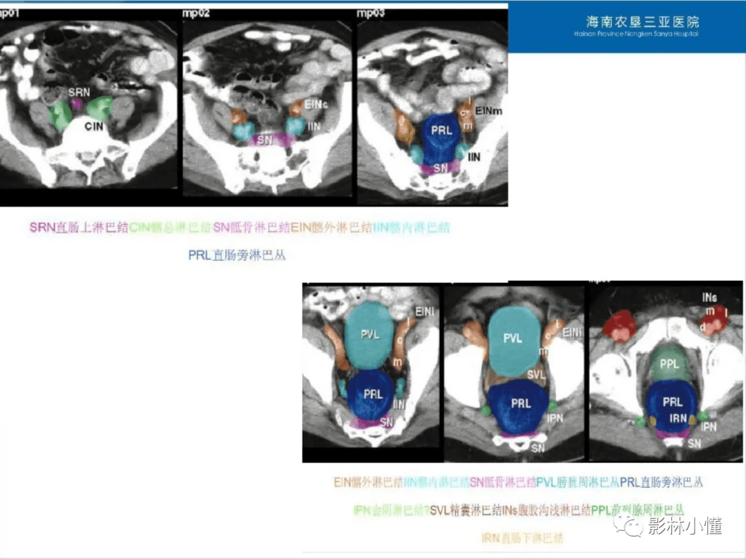 盆腔淋巴结的影像解剖及临床应用