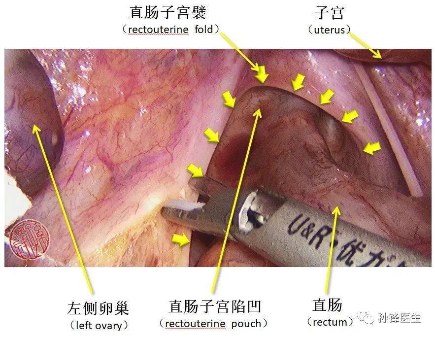 图(8:直肠子宫襞↑输尿管盆部行走于直肠膀胱(子宫)襞外侧,盆腔