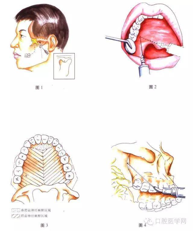 进针点:用25号细长针头,自对侧口角处向患侧腭大孔投影的标志黏膜凹陷