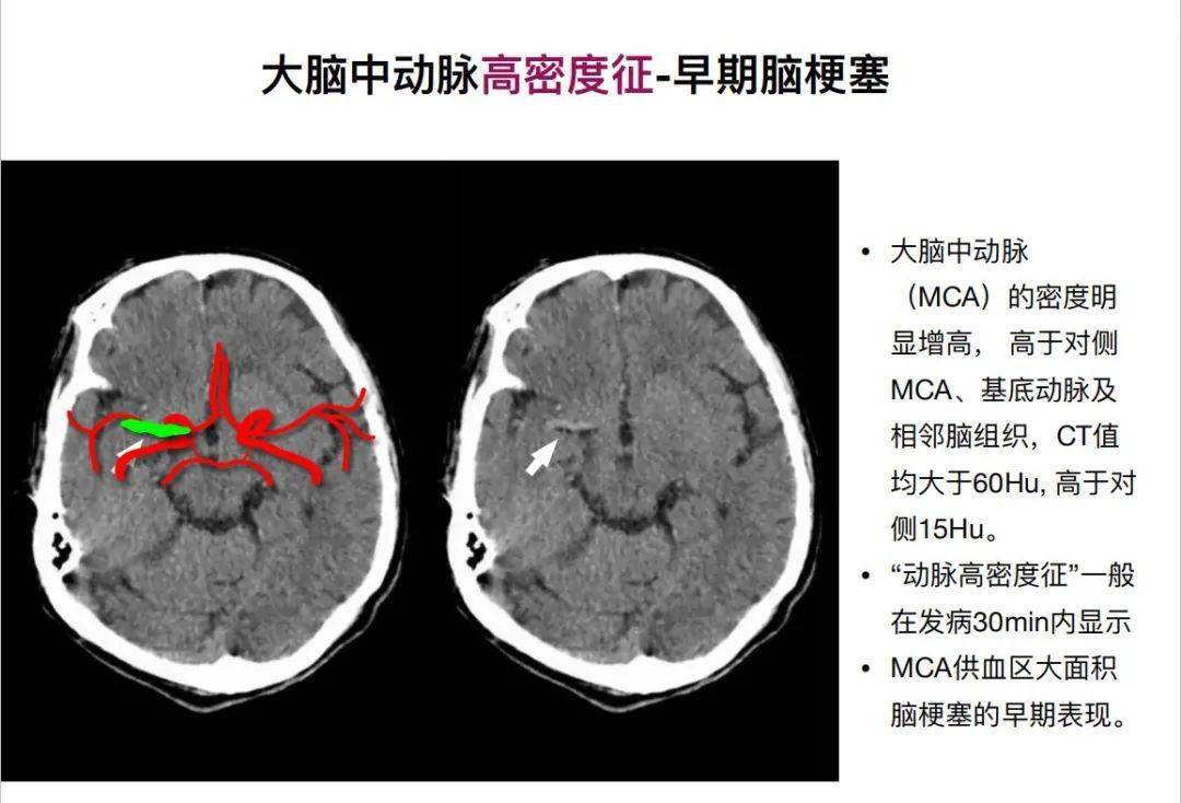 特征性异常脑影像荟萃95绘重置版ct篇