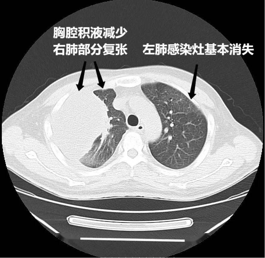 5月28日胸部ct可见右侧大量胸腔积液及左肺感染灶.