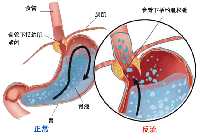 胃食管反流病有什么症状?