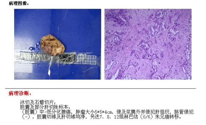 那些深藏不露的胆囊癌