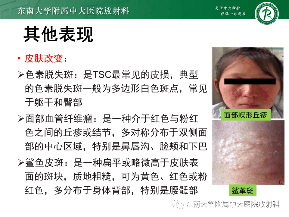 多系统疾病结节性硬化症tsc