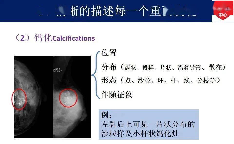 最新版乳腺x线birads分类解读