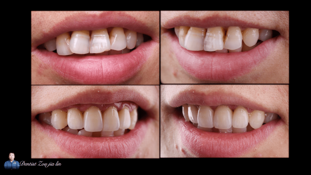 5-2mm,11,12,21,22牙髓永久性摘除 ★正常覆合因内收,需要做成浅覆合