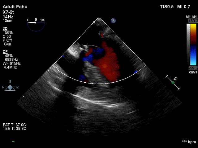多普勒超声提示,主动脉瓣为三叶,窦部结构正常,局部增厚,回声增强,瓣