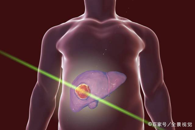 肝脏|警惕！身体出现这9种变化，十有八九是肝硬化，及时做肝脏检查