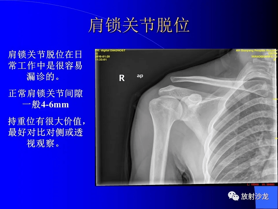 高清收藏:常见骨折/脱位的x线表现
