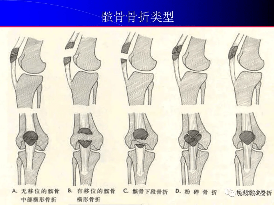 高清收藏常见骨折脱位的x线表现