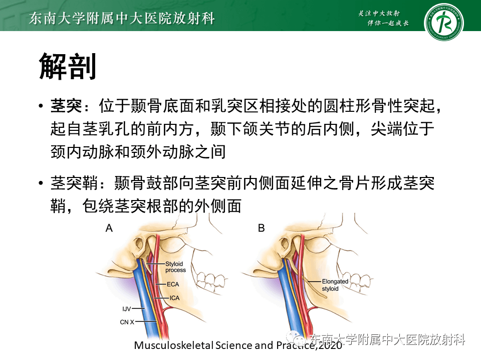 全面梳理:头颈部疾病—茎突综合征