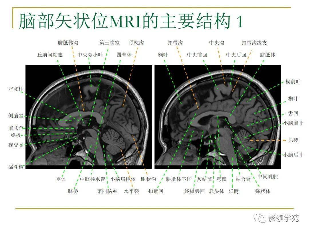 脑mri常用解剖