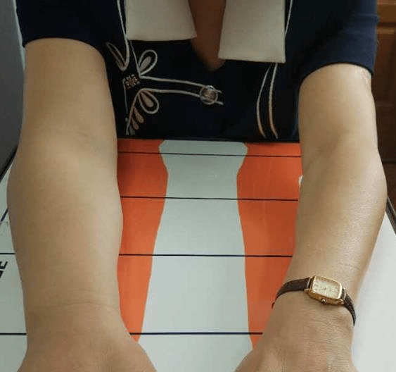 【乳腺癌与手功能障碍】乳腺癌会带来哪些手功能障碍?