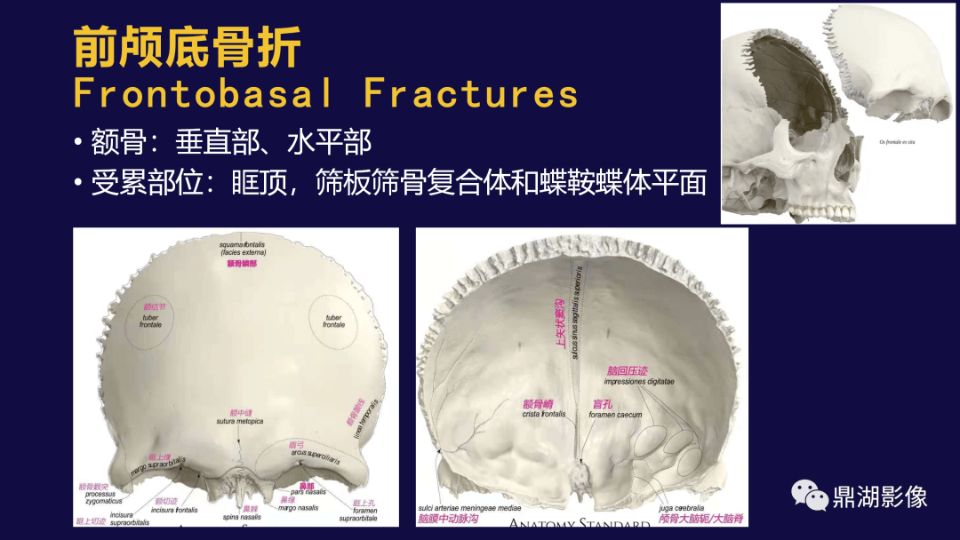 鼎湖精品 | 颅底骨折的分类及相关并发症