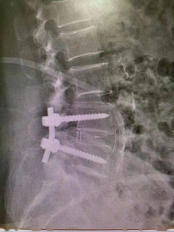 【医疗技术】治疗腰椎间盘突出,看这个微创"明星手术!