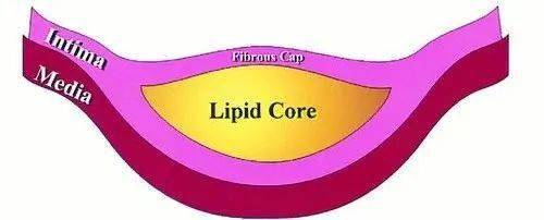 动脉粥样硬化斑块示意,黄色部分为脂核,玫粉色为纤维帽