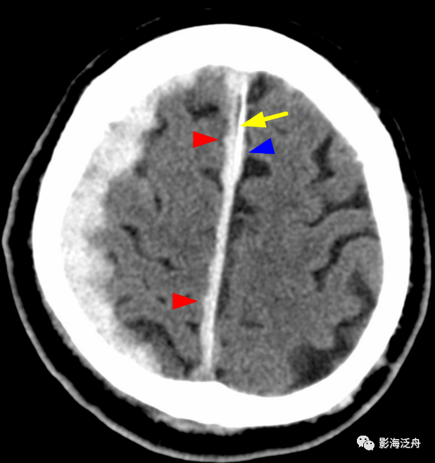 大脑镰旁急性硬膜下血肿与蛛网膜下腔出血的鉴别