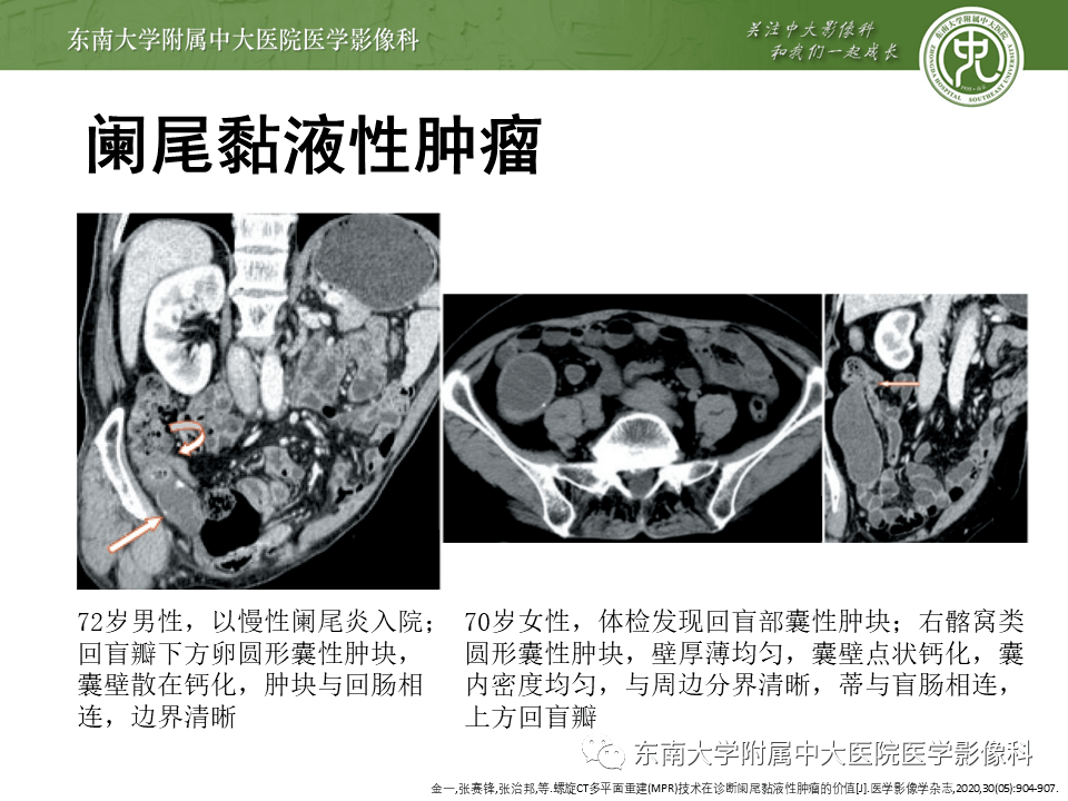 阑尾炎详细ct影像表现解读