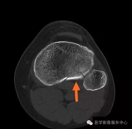 骨小梁模糊*(红箭),考虑平台塌陷骨折,建议ct或mri有没有发现问题?