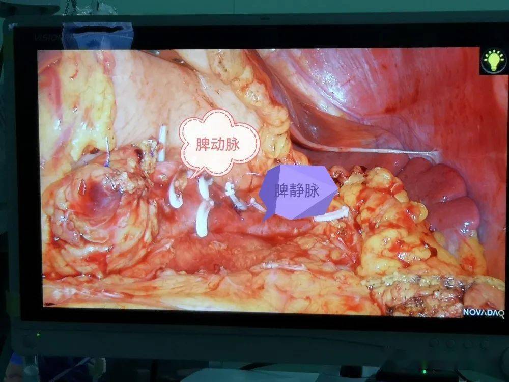 【平医救治故事】我院完成一例保留脾脏腹腔镜下胰腺体尾切除术