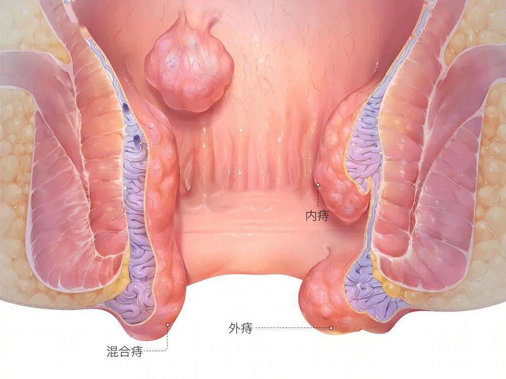 屁股不痛不痒,肯定没痔疮?