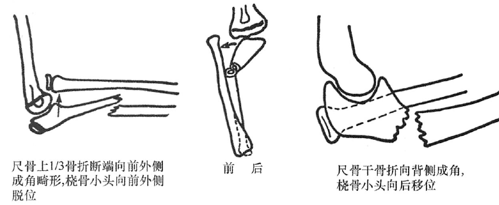 四肢骨折的分型丨上肢骨折及脱位~_肱骨