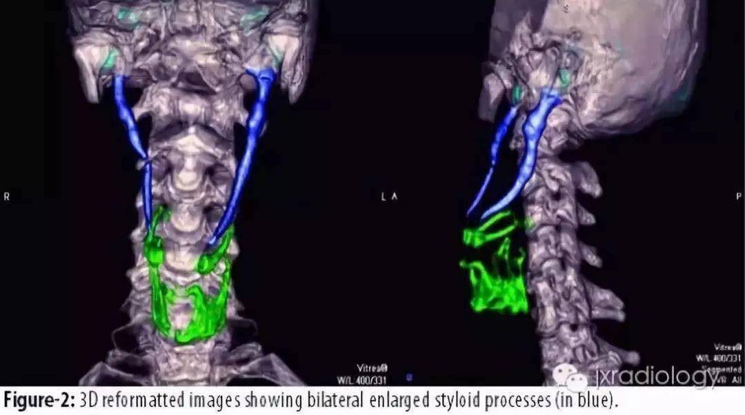 x线对茎突分节及茎突舌骨韧带钙化显示欠佳