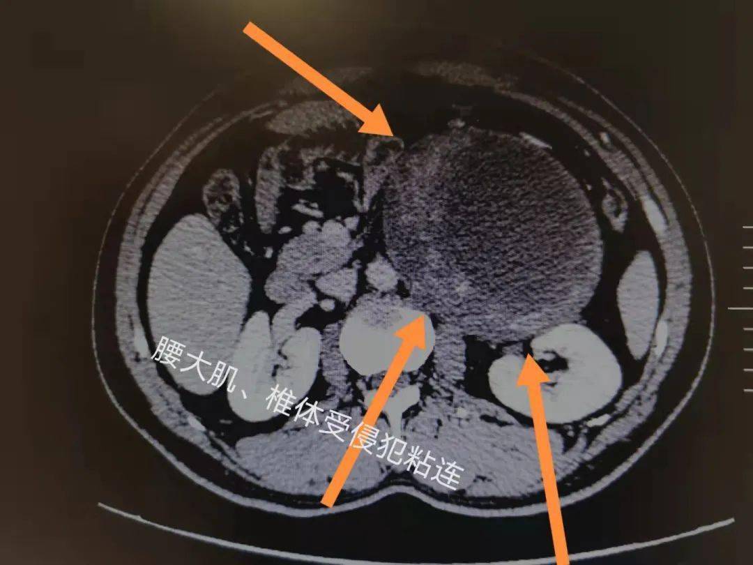 重达5斤慈林医院泌尿外科成功切除一例腹膜后巨大肿瘤