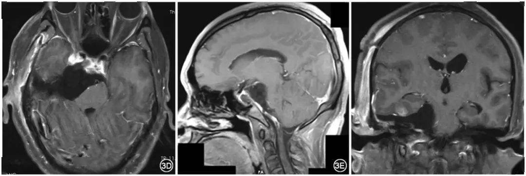 赵子进岩斜坡区脑膜瘤分型及手术治疗效果的临床研究