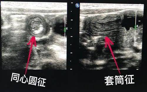 一看就会!教您在超声检查中识别肠套叠