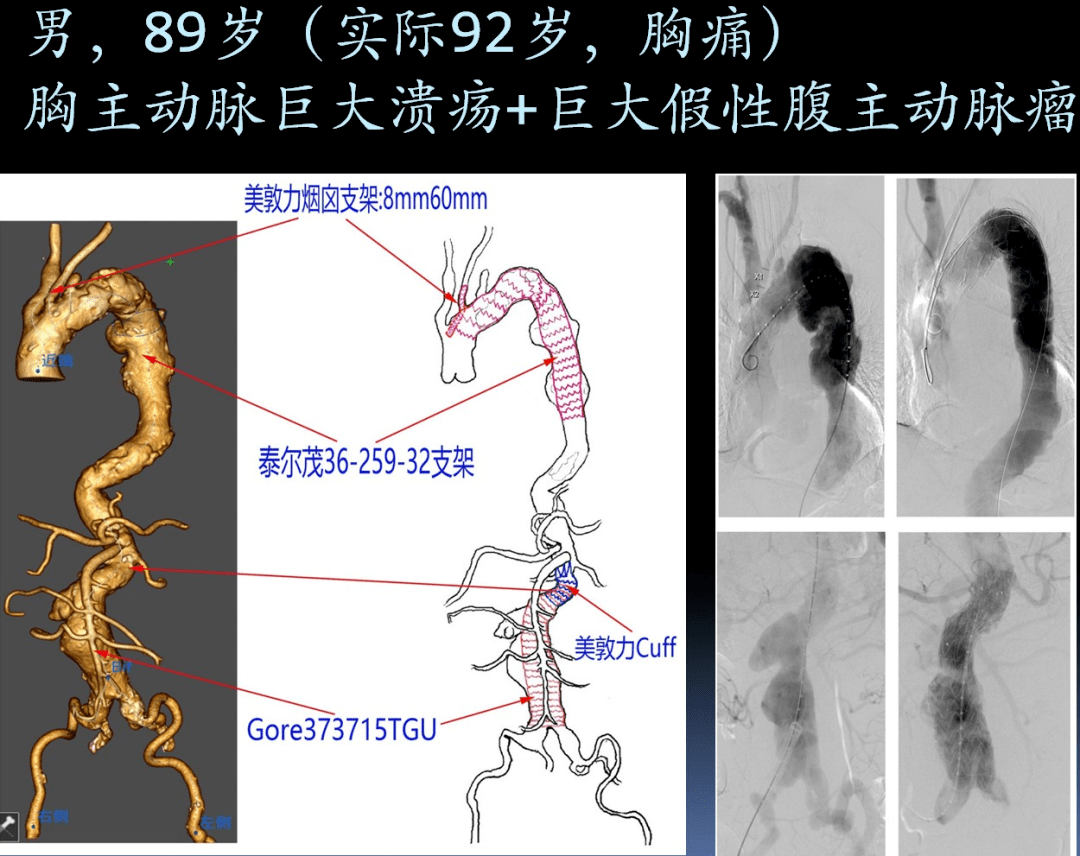 动脉病变累及主动脉弓,降主动脉,腹主动脉及髂总动脉,涉及弓上分支