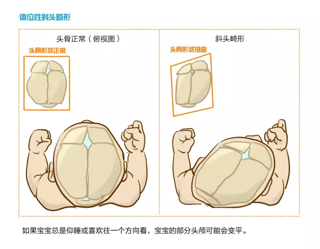 【健心课堂】宝宝头睡扁了怎么办?医生妈妈教你"圆"回来