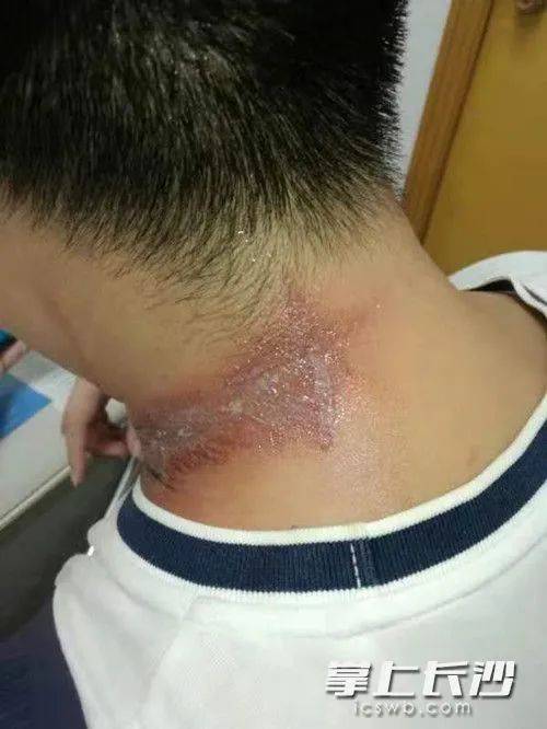 头颈部|警惕！近期高发！长沙有医院7天接诊百余例