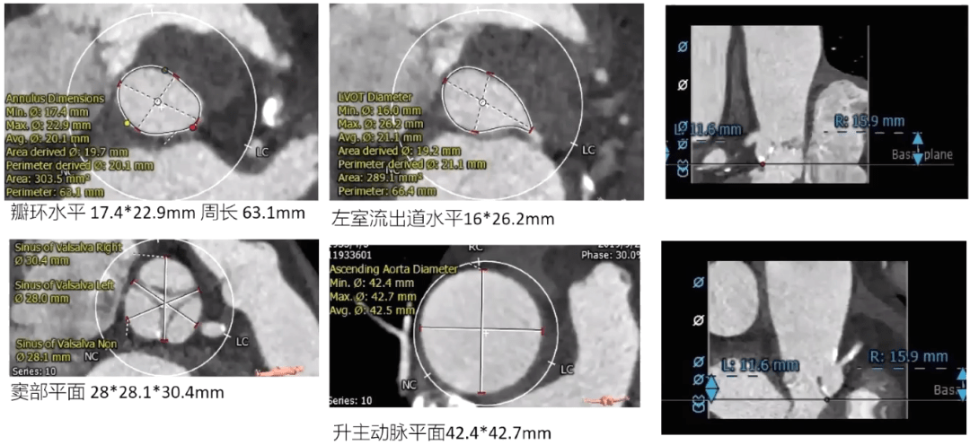 中国结构周2021宋光远姚晶简约而不简单极简式tavr发展