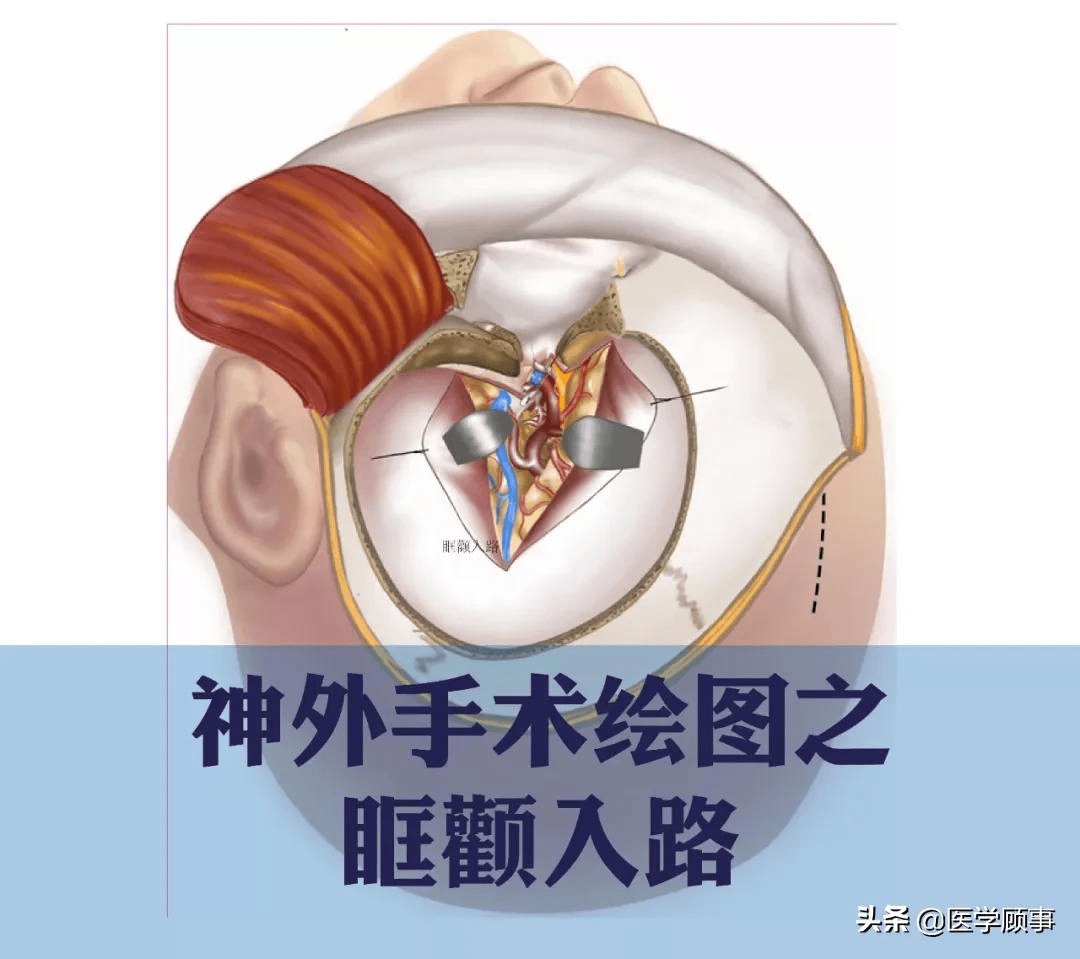 神经外科手术绘图:眶颧入路