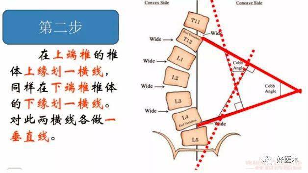 骨科常用的角度测量方法汇总,全在这里了!_cobb