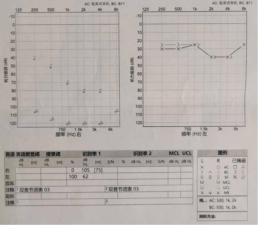 神经外科梁建涛,宋刚,李晓宇,兰天听神经瘤团队和在国内外人工耳蜗