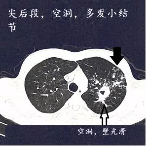 十二个病人的肺ct图像详细解读_结核