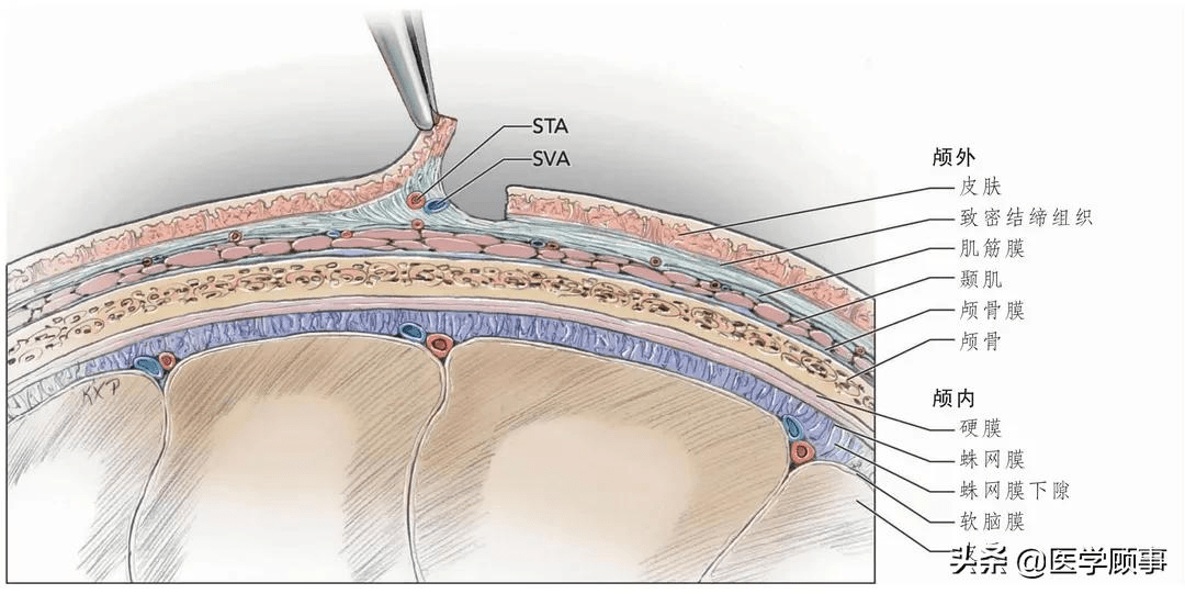 图1 颅外-颅内血管搭桥头皮血管解剖.