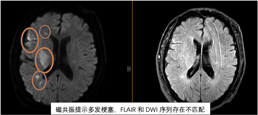 仔细评估敢决断脑梗介入显身手