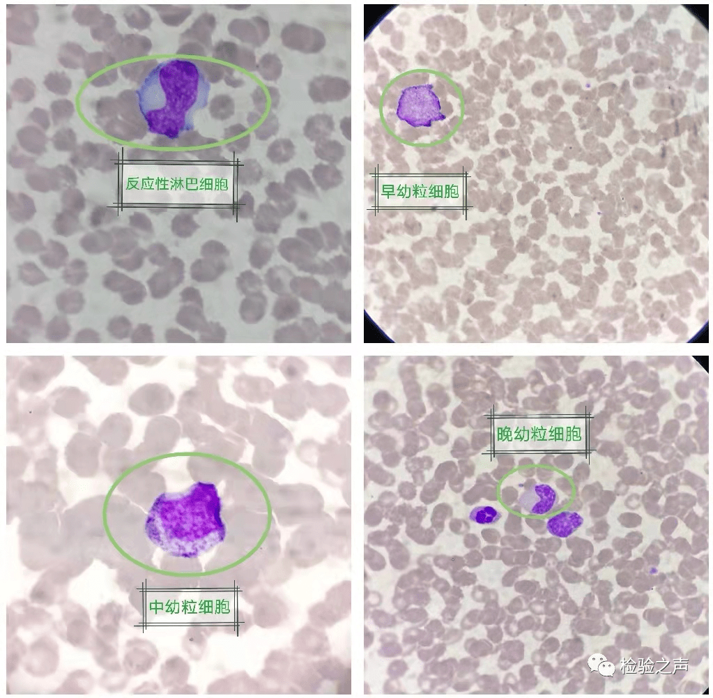 推片镜检(瑞吉染色 1000:反应性淋巴细胞约占18,早中晚幼粒细胞约