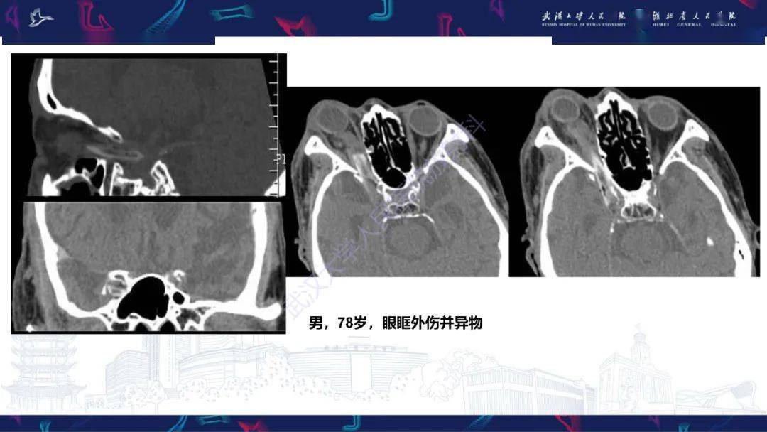 眶尖疾病影像诊断