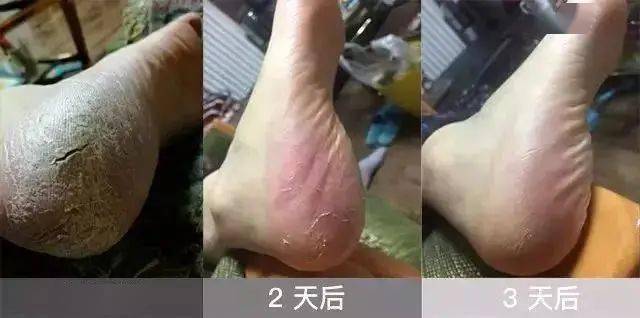 身边  生冻疮的朋友用了一个星期,红肿,皲裂的地方一点痕迹都看不出来