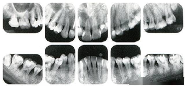 牙周病的分类加病例图解