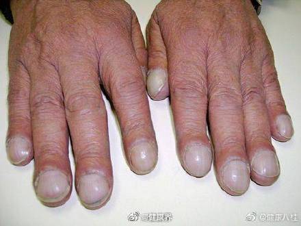 女子手指肿成萝卜头一查是肺癌