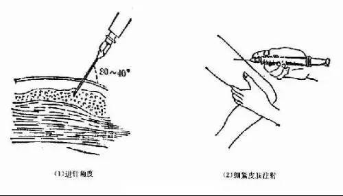 护士常用各种注射法大全_部位_药液_针头