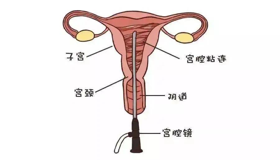 b超检查反复提示子宫内膜很薄,而且提示可能存在"宫腔粘连"