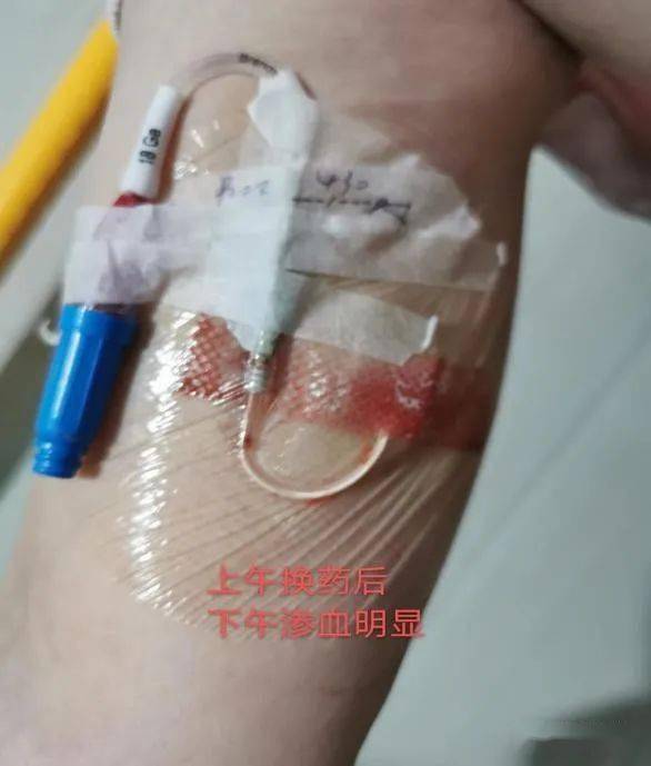穿刺点渗液渗血不断怎么办? 处理对策,一文掌握!_贴膜_患者_导管